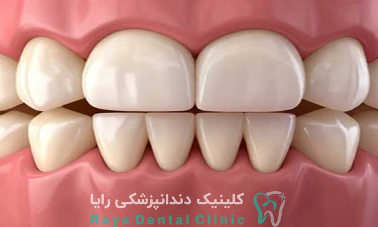 جرمگیری دندان 