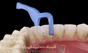 علت خراب شدن دندان