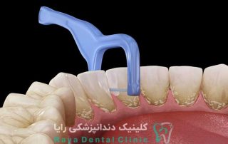 علت خراب شدن دندان