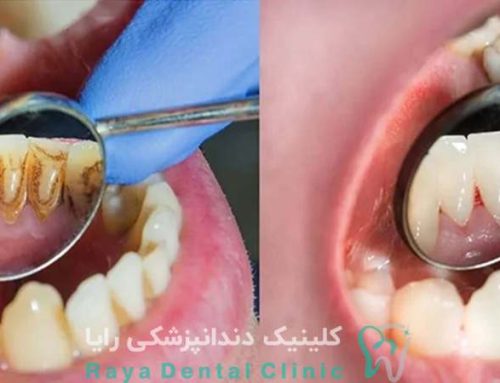 جرم دندان فقط مسئله زیبایی است یا خطرناک هم هست؟