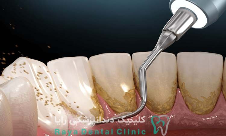 علت ایجاد جرم دندان