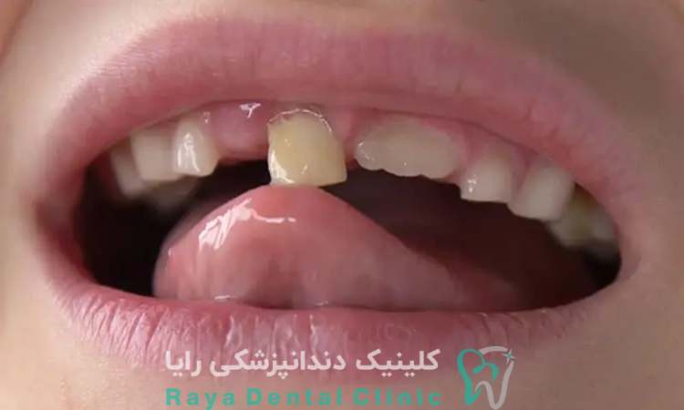 درمان لق شدن دندان
