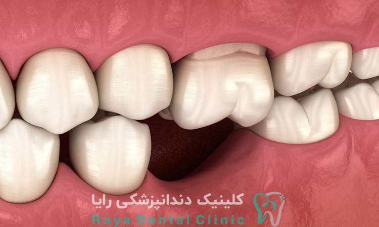 پیشگیری لق شدن دندان