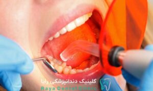 پر کردن دندان