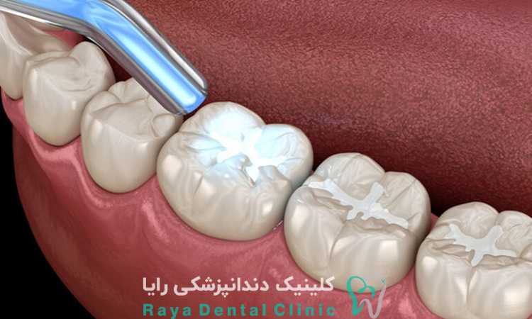 روش پر کردن دندان