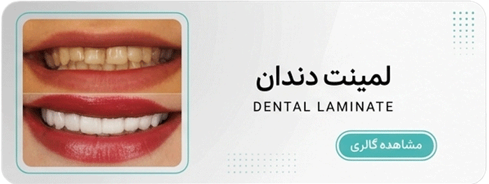 لمینت دندان
