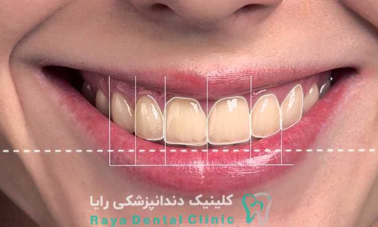 طرح لبخند چیست