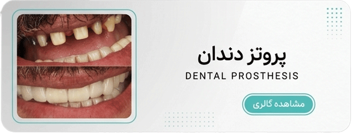 پروتز دندان