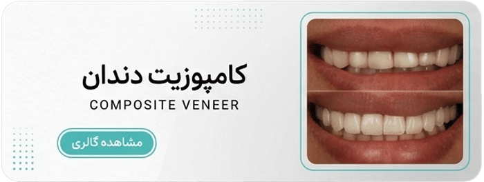 کامپوزیت دندان