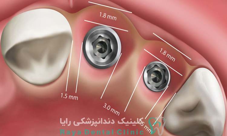 قیمت ایمپلنت دیجیتال