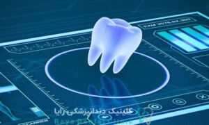ایمپلنت دیجیتال