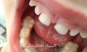 دندان شیری پوسیده