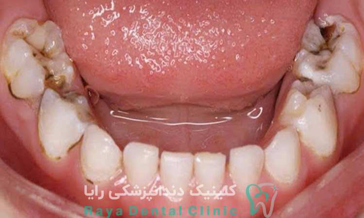 ترمیم دندان شیری پوسیده
