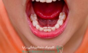 درمان رویش نابجای دندان