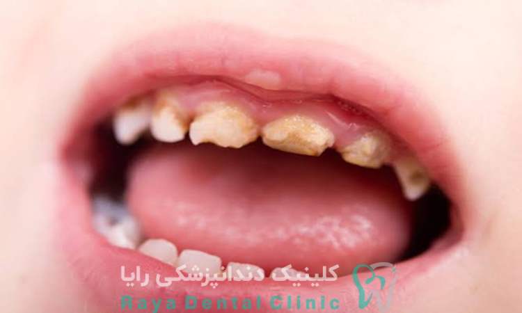 اهمیت حفظ دندان شیری