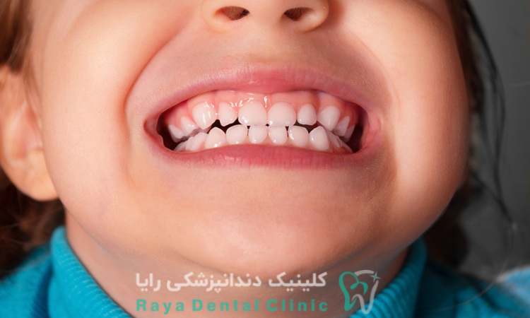 رویش نابجای دندان دائمی
