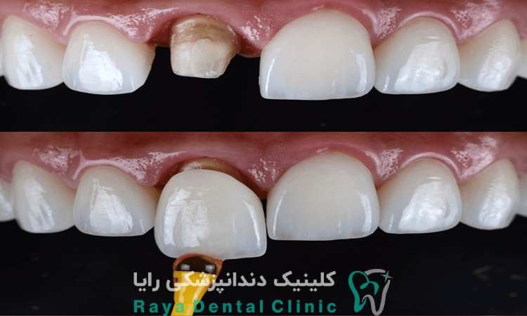 علت لق شدن دندان