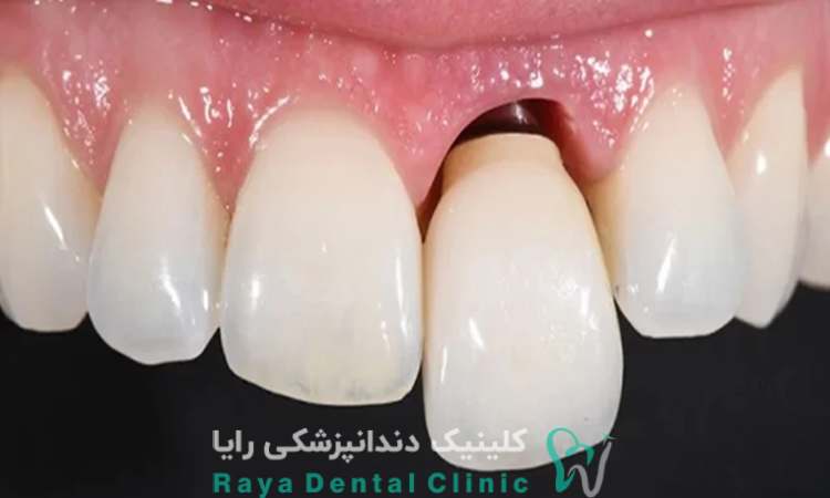 پيشگيري از جدا شدن روکش