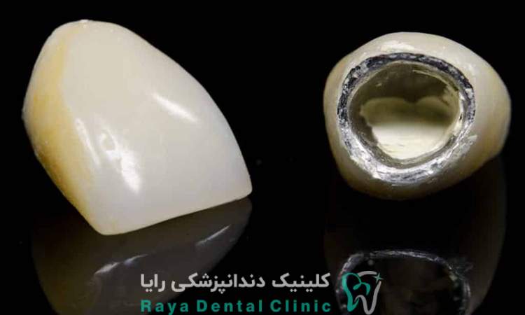 پوسیدگی زیر روکش