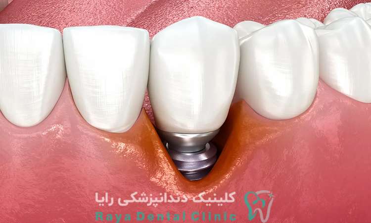 بافت نرم چیست؟