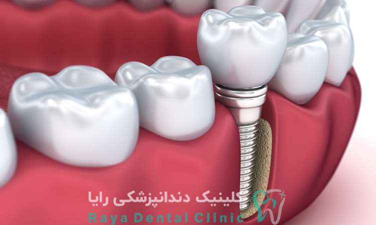 طراحی ایمپلنت دیجیتال