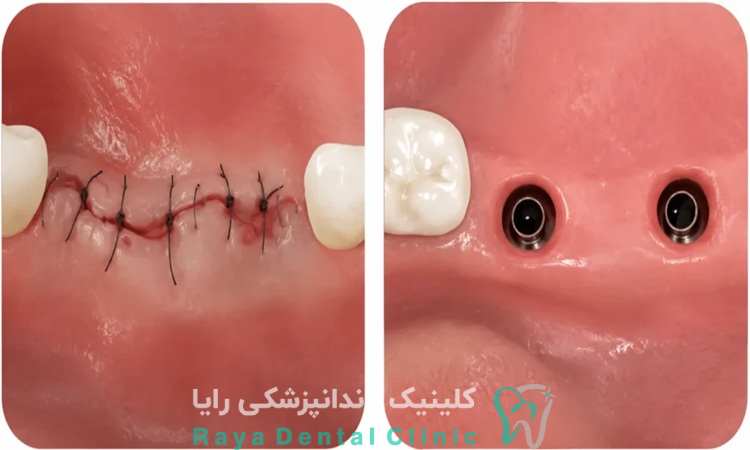 جراحی ایمپلنت بدون فلپ