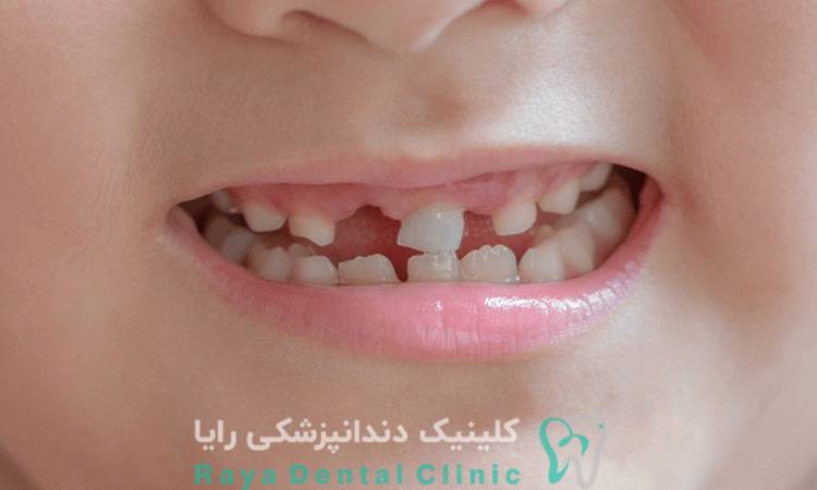 شکستگی دندان شیری و دائمی