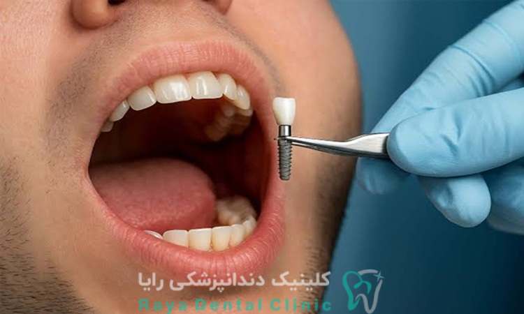 کاشت ایمپلنت دندان