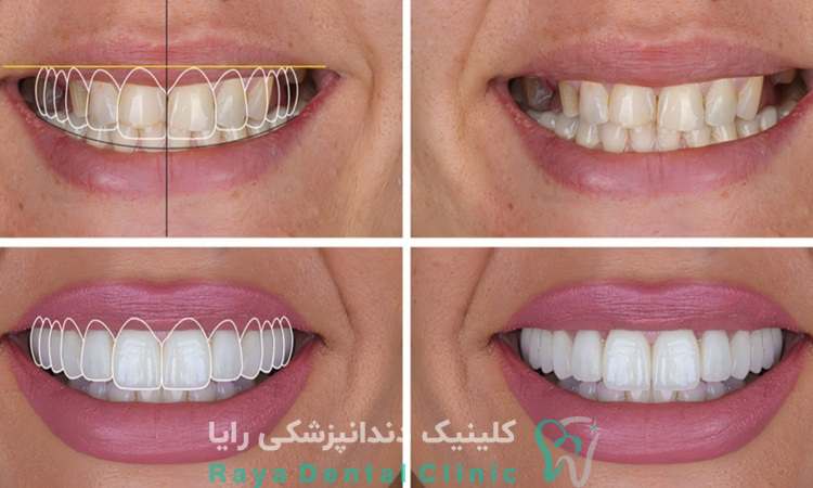 طراحی لبخند دیجیتال
