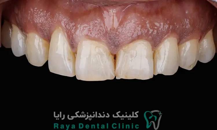 هیپومینرالیزاسیون دندان مولر