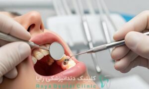 عمر ایمپلنت دندان