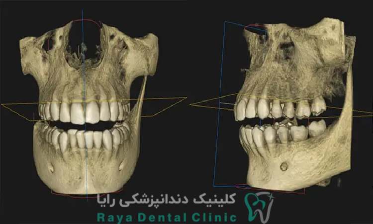 نقش CBCT در ارزیابی محل ایمپلنت