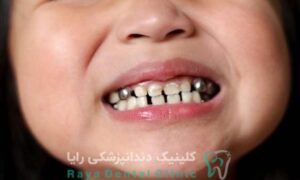 ترمیم دندان شیری