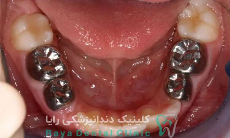 روکش استیل دندان شیری