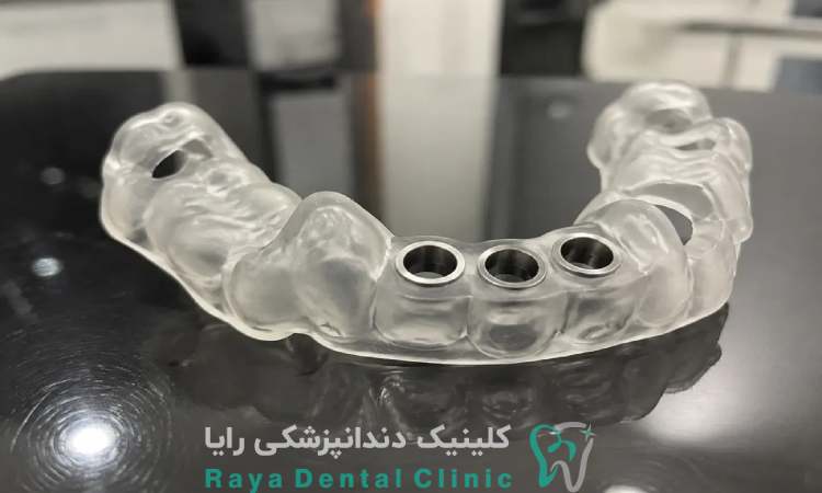 گاید جراحی کاشت ایمپلنت
